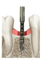Wykonanie łoża dla implantu kalibrowanym frezem