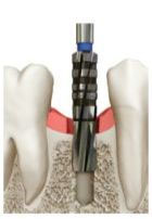 Kolejne frezy nadają mu odpowiednią średnicę i kształt