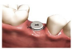 Wykonanie łoża dla implantu kalibrowanym frezem