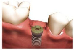 Wykonanie łoża dla implantu kalibrowanym frezem